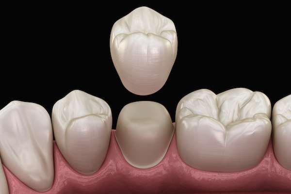 What To Ask Your General Dentist When Preparing for a Crown from Stone Canyon Dental in Sunnyvale, TX