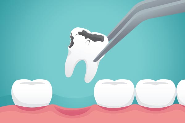 Ask a General Dentist: What Happens to Your Tooth After Extraction from Stone Canyon Dental in Sunnyvale, TX