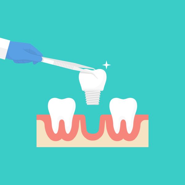 Consider All On   If You&#   ;re Missing All Upper Or Lower Teeth