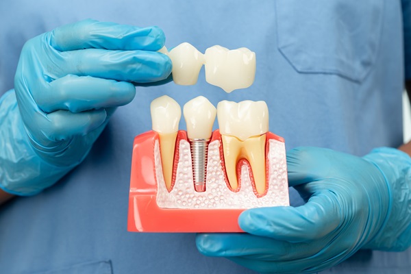 Are There Age Restrictions For Dental Implants?