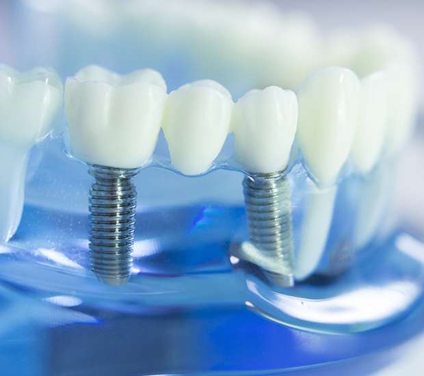 Sunnyvale Dental Implants