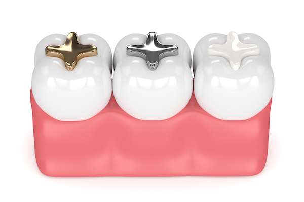 A General Dentist Discusses Different Filling Options from Stone Canyon Dental in Sunnyvale, TX