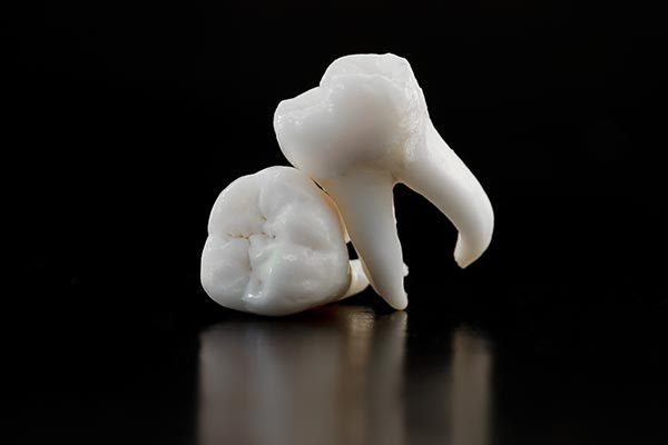 A General Dentist Talks Tooth Extractions from Stone Canyon Dental in Sunnyvale, TX