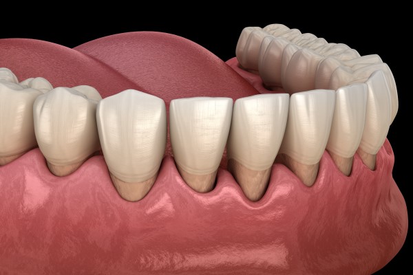 Three Common Treatments For Gum Disease
