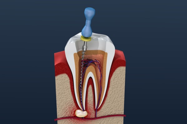 Root Canal Treatment Sunnyvale, TX