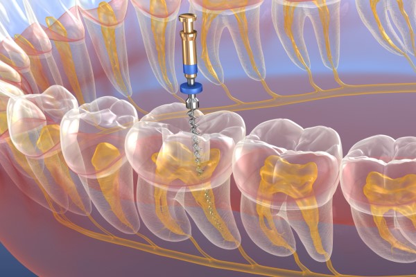 Root Canal Treatment Sunnyvale, TX